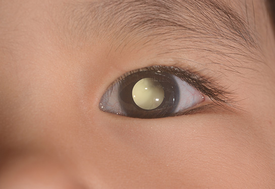 An example of leukocoria where the eye reflects a yellowish color instead of red. 