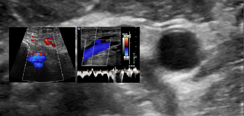 Vascular Sonography 