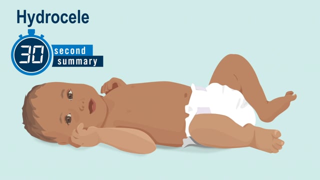 30-Second Summary: Hydrocele