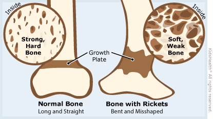 A side-by-side look at a strong, straight bone and a soft, bent bone that's weak because of rickets.