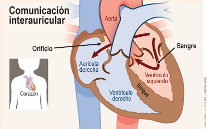 Se muestran dos ilustraciones. Una muestra la posición del corazón en el cuerpo y la otra un primer plano del corte transversal de un corazón con una comunicación interauricular. Un poco de sangre fluye normalmente de la aurícula izquierda al ventrículo izquierdo para luego dirigirse hacia la aorta.  Pero el orificio que hay en el tabique, también permite que la sangre fluya directamente desde la aurícula izquierda y llegue a la aurícula derecha.