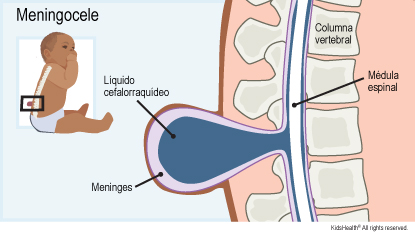 Saco con meninges y líquido cefalorraquídeo que sobresale por una abertura de la columna. Médula espinal en el canal medular.