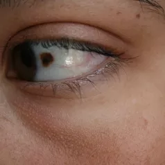 Eye vascular anomaly