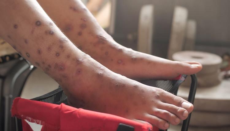 Lesões de escabiose na região dos tornozelos e pés de adolescente