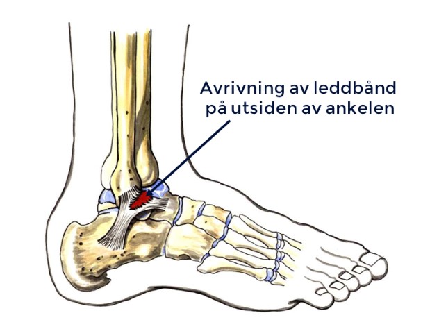 Avrivning av ytre leddbånd i ankelen