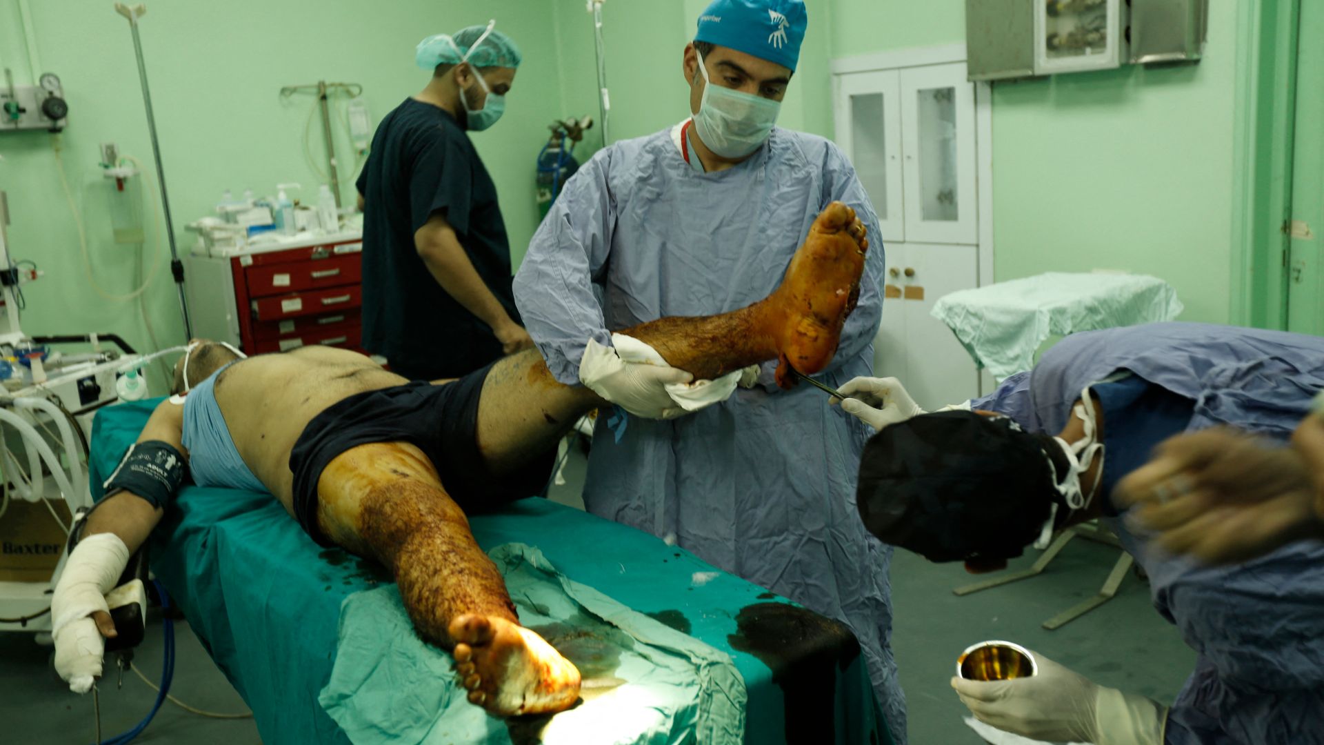 TO GO WITH AFP STORY BY GUILLAUME LAVALLEE Doctor Ghassan Abu Sitta (R) and other doctors treat a patient suffering from severe burns at the Al-Shifa hospital in Gaza City, on August 3, 2014. A third of hospitals have been hit during the fighting and the violence has prevented nearly half of medical staff from reaching the clinics and health centres that are still standing. AFP PHOTO/ MOHAMMED ABED (Photo by MOHAMMED ABED / AFP)