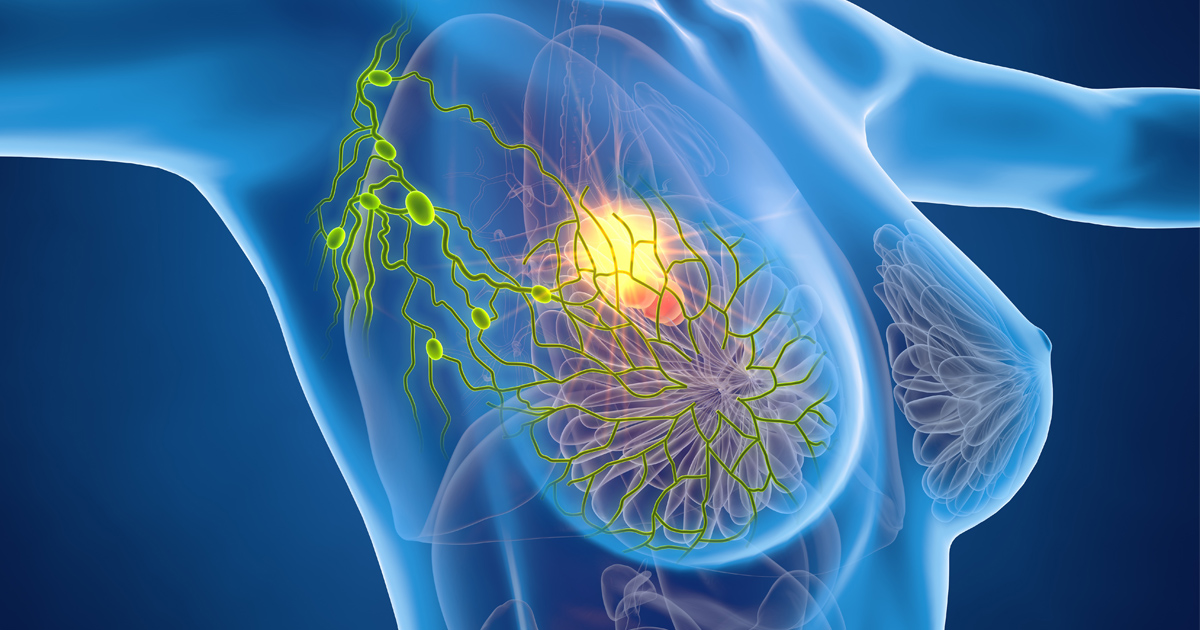 リンパ節転移陰性の浸潤性乳がん、腋窩手術省略vs.センチネルリンパ節生検／NEJM