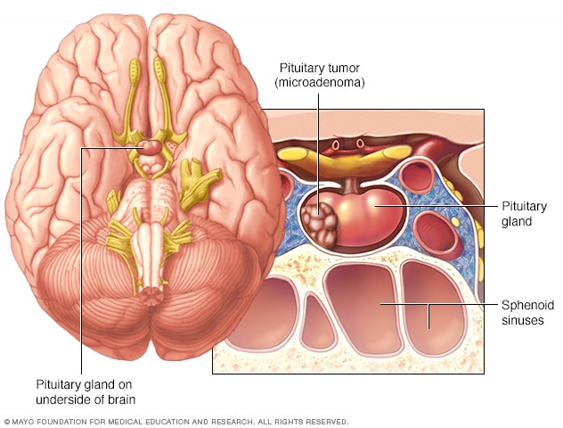 Tumor hipofisario