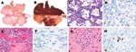 Thumbnail of Lesions and associated expression of influenza virus antigen in respiratory and extrarespiratory organs of foxes infected intratracheally with HPAI virus (H5N1), at 7 days postinoculation. A) Lungs of control fox sham-inoculated with phosphate-buffered saline. B) Lungs of intratracheally inoculated fox presenting extensive consolidated lesions (darkened areas), characterized by C) diffuse alveolar damage and regeneration (type II pneumocyte hyperplasia) and D) expression of influenz