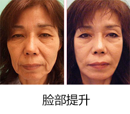 脸部提升