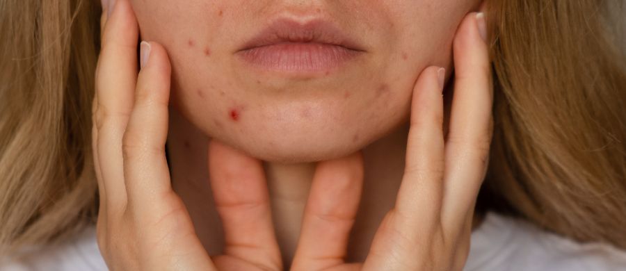 CBD e possibilidades no tratamento da acne