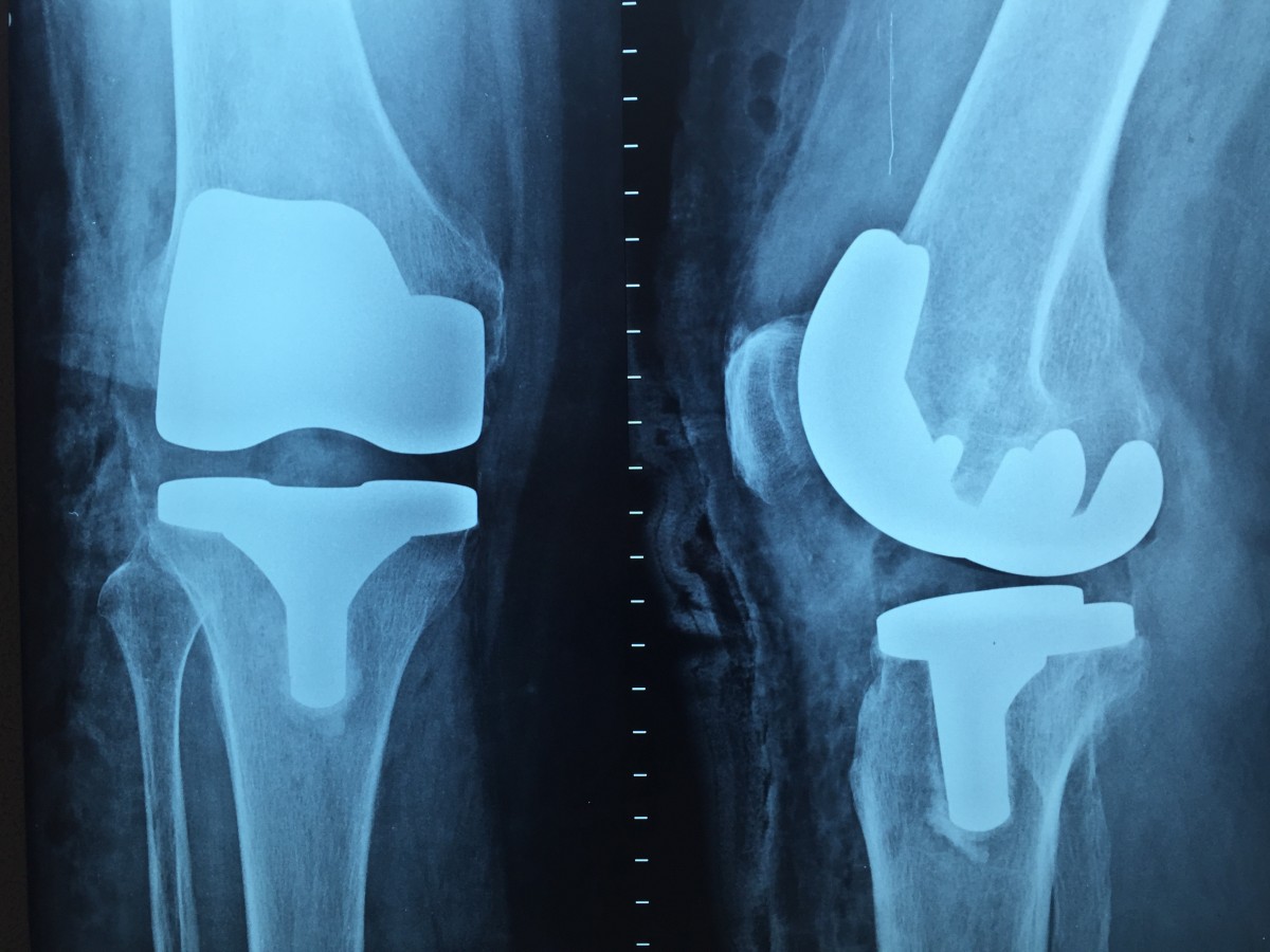 törzs, kar, mellkas, emberi test, szerv, térd, orvos, orvosi, x ray, érzék, ortopédia, radiológia, orvosi képalkotás, röntgenográfia, orvosi röntgen