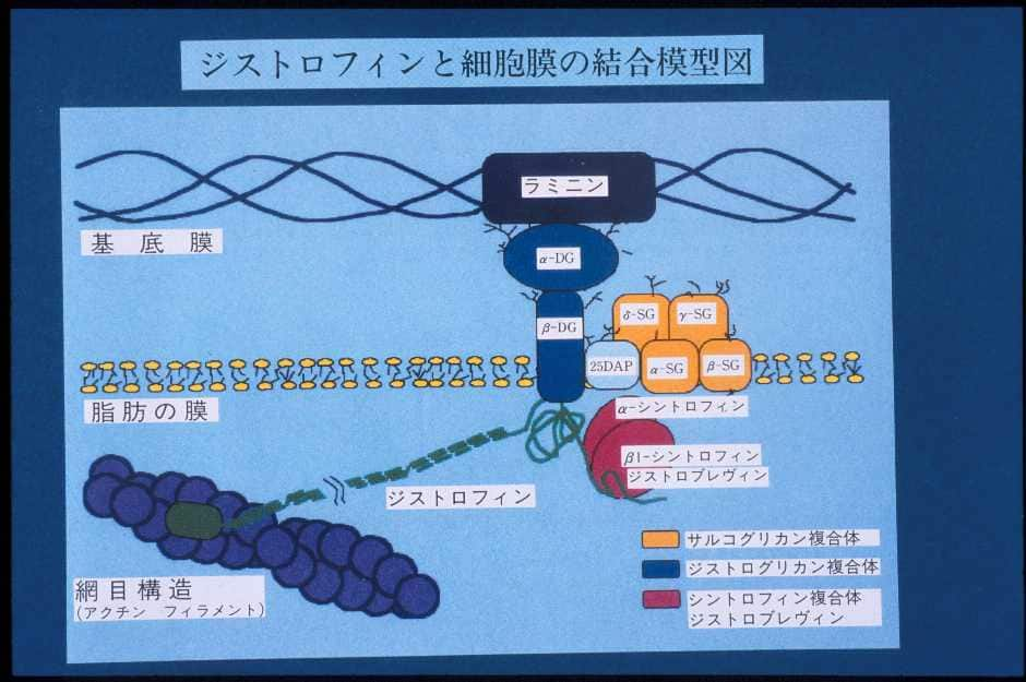 デュシェンヌ型筋ジストロフィー