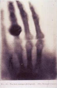 First Röntgen x ray photograph of a hand.