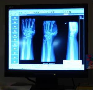 An x ray of hands on a computer monitor.