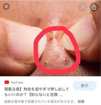 高3の女子です 鼻の毛穴を押し出す癖が止まらなく、その結果、写真のような毛穴になってしまいました、、、
どうすれば治りますか？
また、歳を重ねるにつれ、目立たなくなったりなくなったりしますか？