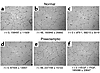 Preeclampsia is an antiangiogenic state due to excess sFlt1. Endothelial tu