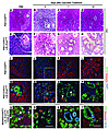 Mutant Kras blocks acinar regeneration and promotes ADM/PanIN formation.