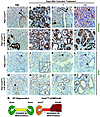 Mutant Kras blocks acinar regeneration in favor of a persistently dediffere