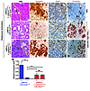 Stabilized β-catenin antagonizes Kras-induced ADM.