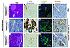 β-catenin signaling inhibits Kras-induced reprogramming of acini into PanIN