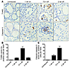 Withdrawal of BRAFV600E expression leads to thyroid cancer cell apoptosis.