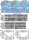 p-Dock180Y1811, p-SrcY418, and PDGFRα are coexpressed in primary human glio