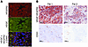 The VEGF:VEGFR2 feed-forward loop in primary human lung adenocarcinomas.