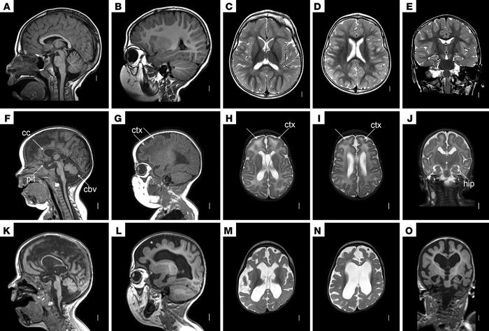 MRI scan images of patient NM720.
Brain MRI in a normal 3-year-old child...