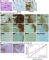 Organization of the immune infiltrate in extensively infiltrated breast tum