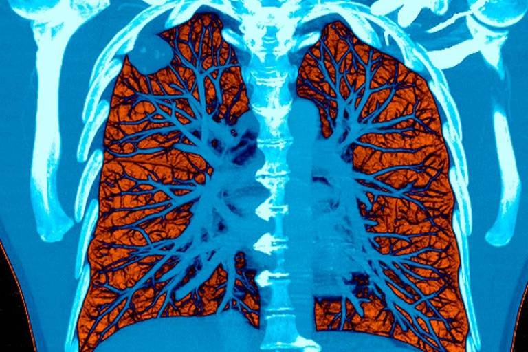 Tomografia computadorizada colorida (nas cores vermelha e azul) mostra pulmão com câncer