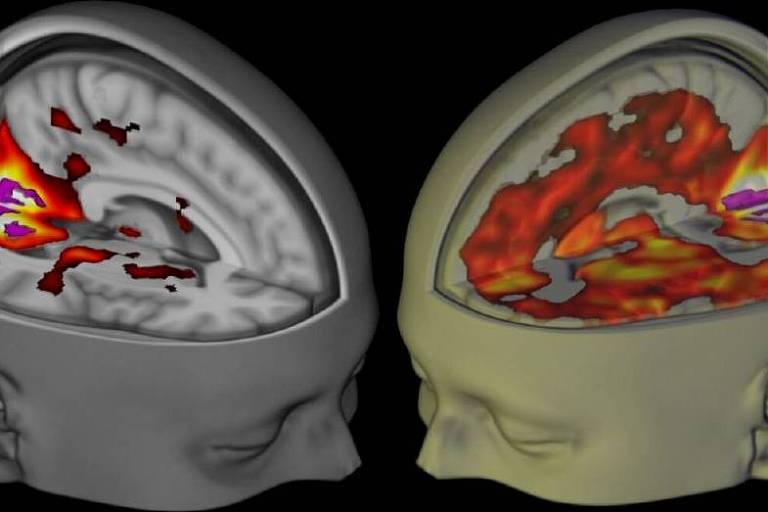 Imagem de ressonância magnética nuclear mostra atividade de cérebro sob placebo (esq.) e sob LSD (dir.)