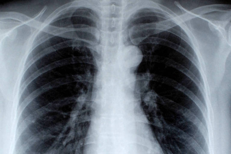 Saiba como diferenciar a DPOC de outras doenças pulmonares, como asma e bronquite