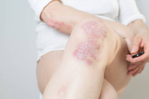 Acute psoriasis on the body and elbows is an autoimmune incurable dermatological skin disease. Large red, inflamed, flaky rash on the knees. Joints affected by psoriatic arthritis. (Foto: SNAB / Stock adobe )