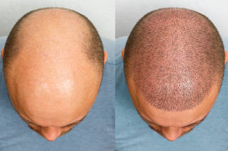 The head of a balding man before and after hair transplant surgery. A man losing his hair has become shaggy. An advertising poster for a hair transplant clinic. Treatment of baldness.