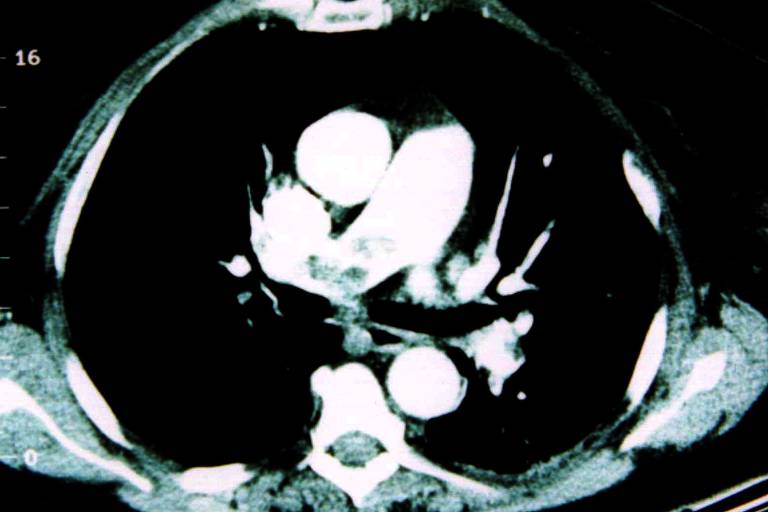 Entenda a trombose venosa