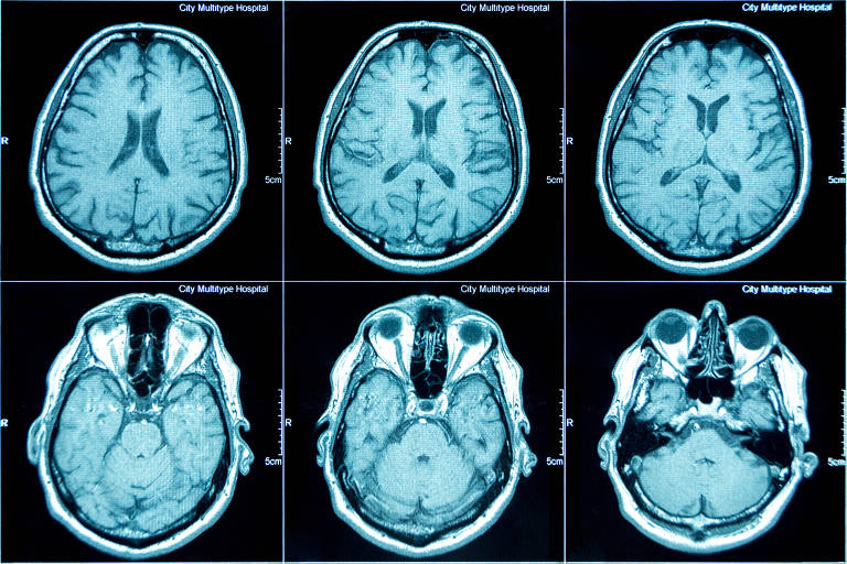 Proteínas podem prever demência 10 anos antes do diagnóstico, sugere estudo