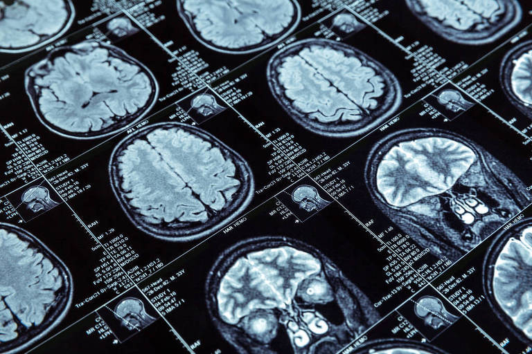 Imagens de tomografia de cérebro
