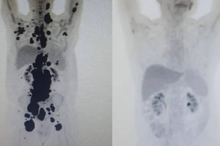 Exames mostram antes e depois de câncer de paciente tratado com CAR-T; à direita, imagem mostra remissão da doença. Cientistas investigam uso da terapia para outras doenças