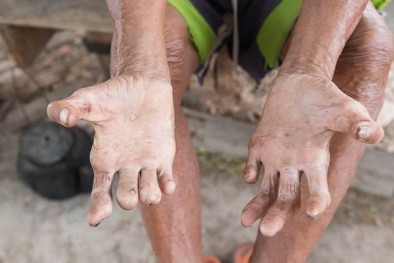 Por que Brasil é o segundo país com mais casos de hanseníase no mundo