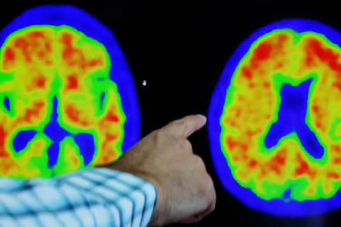 A doctor points out evidence of Alzheimer?s disease on PET scans at the Center for Alzheimer Research and Treatment (CART) at Brigham And Women?s Hospital in Boston, Massachusetts, U.S., March 30, 2023.     REUTERS/Brian Snyder/ ORG XMIT: FW1
