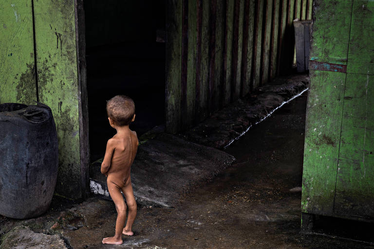 Criança yanomami com desnutrição grave internada no Polo Base de Surucucu, na Terra Indígena Yanomami, em Roraima