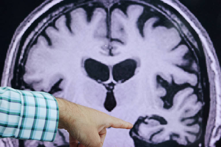 Médico aponta para área do cérebro afetada pelo Alzheimer em ressonância magnética cerebral tirada no Centro de Pesquisa e Tratamento de Alzheimer, do Hospital Brigham para Mulheres em Boston, Massachusetts (EUA) 