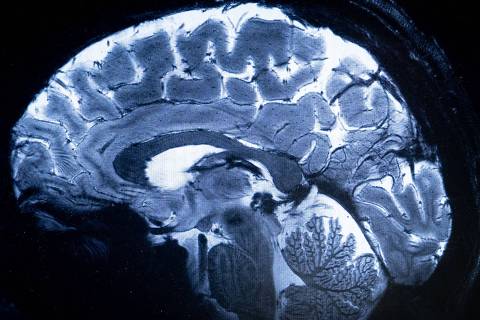 This image made with the Iseult Magneton 11.7 T MRI shows a brain during a magnetic resonance imaging (MRI) exam simulation at the Neurospin facilities in the Paris-Saclay Alternative Energies and Atomic Energy Commission (CEA - Commissariat a l'energie atomique et aux energies alternatives) centre in Gif-sur-Yvette, on March 22, 2024. 