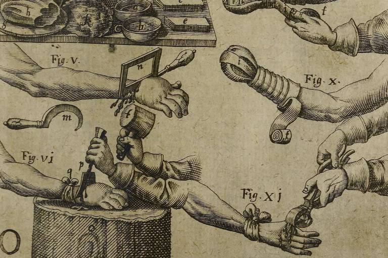 Como serras, amputações e mãos de ferro transformaram o corpo na Renascença