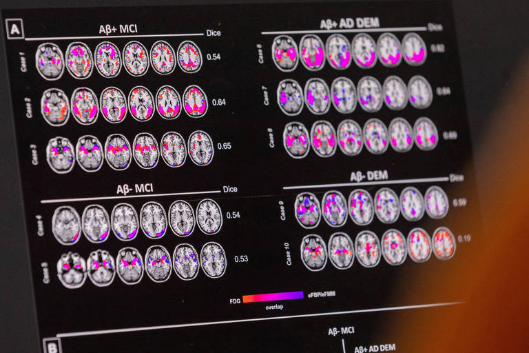 Após 18 anos, influente estudo sobre Alzheimer pode ser retratado devido a imagens manipuladas