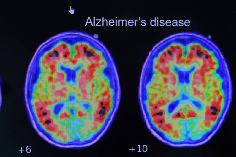 Cientistas desenvolvem spray nasal que elimina proteína ligada à doença de Alzheimer