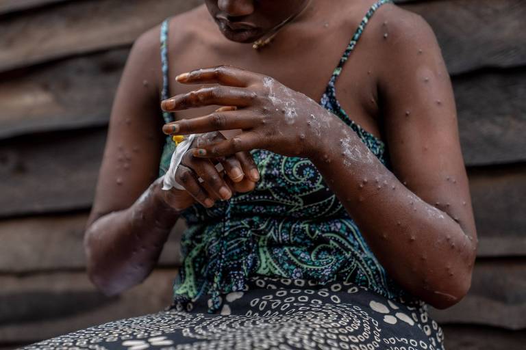 Gotículas respiratórias são via 'menor' de transmissão da mpox, segundo a OMS