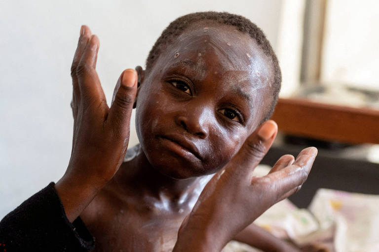 Combater o estigma da Mpox é fundamental para acabar rapidamente com o surto no Burundi, diz Unicef