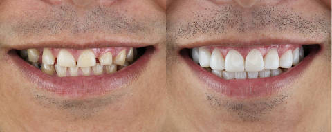 Smile makeover porcelain laminated veneers result. Foto: nelson/Adobe Stock DIREITOS RESERVADOS. NÃO PUBLICAR SEM AUTORIZAÇÃO DO DETENTOR DOS DIREITOS AUTORAIS E DE IMAGEM